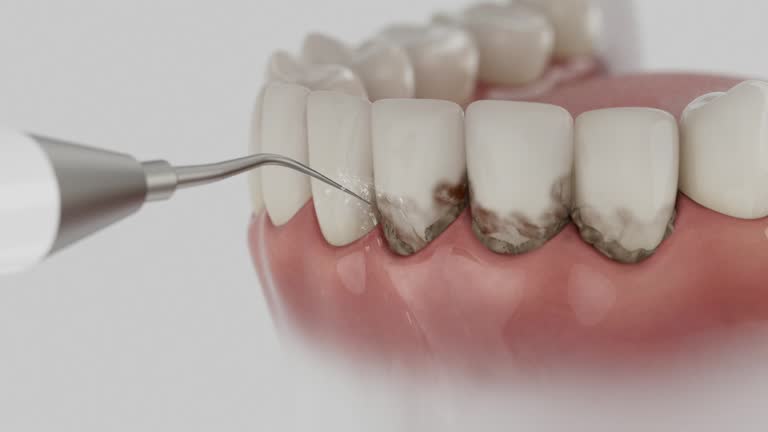 Reliable Tooth Extraction contractor in Bluewell, WV by Smile Center Dentistry